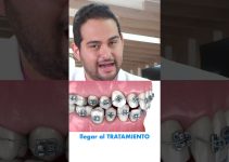 revisi&oacute;n de tuber&iacute;as con crecimiento radicular